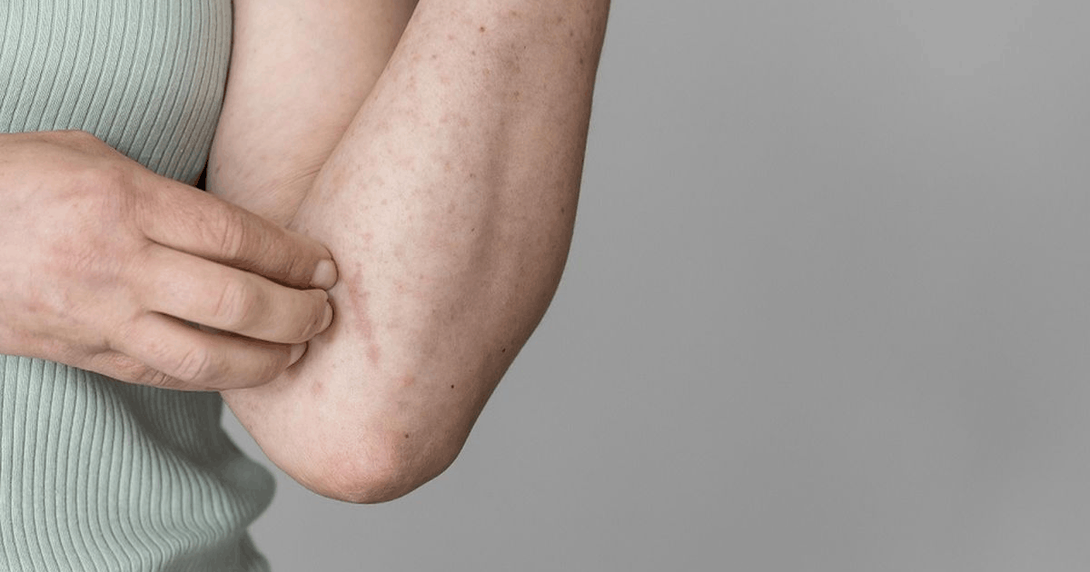 Waspada! Perhatikan 2 Tanda di Kulit yang Bisa Jadi Gejala Sakit Ginjal