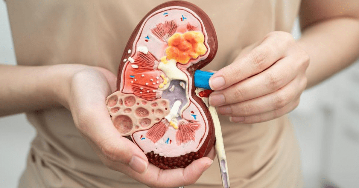 Tragis! Jari Wanita Ini Diamputasi Akibat Komplikasi Batu Ginjal