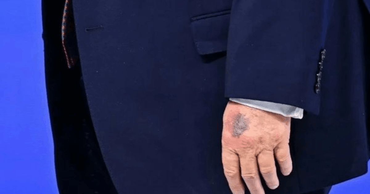 kesehatan Donald Trump