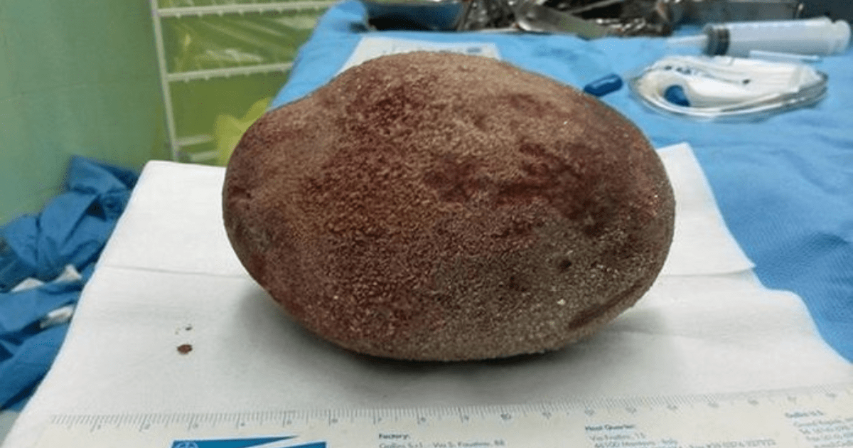 Ngeri! Penampakan Batu Kandung Kemih Raksasa Seberat 1 KG