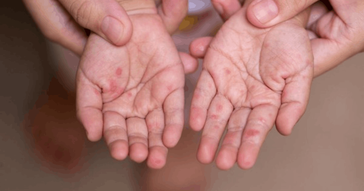 Australia Temukan Virus Campak dari Indonesia: Pakar Beri Peringatan