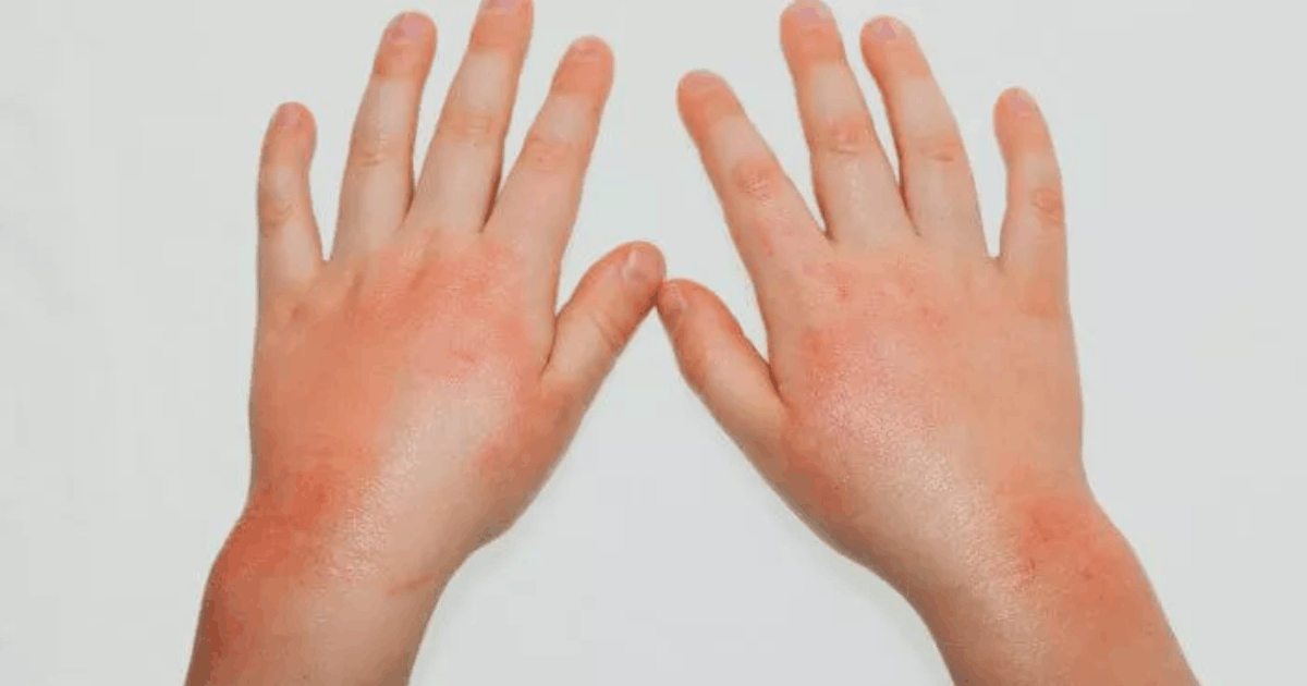 Kasus Campak di RI Disorot Eks Petinggi WHO: Dampak Temuan Australia