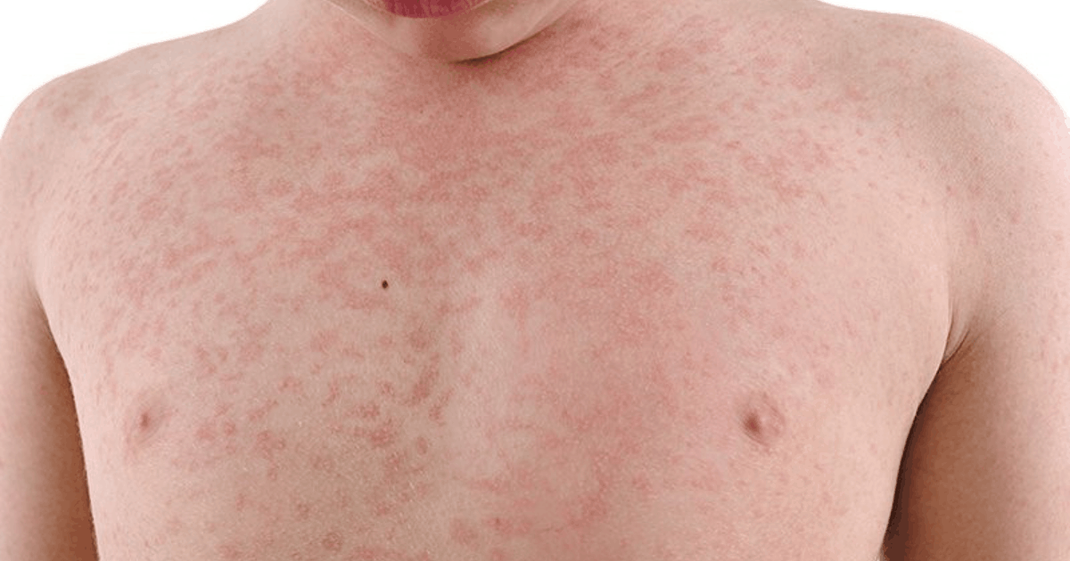 Waspada! Gejala Campak pada Anak Meningkat, Simak Cara Mencegahnya