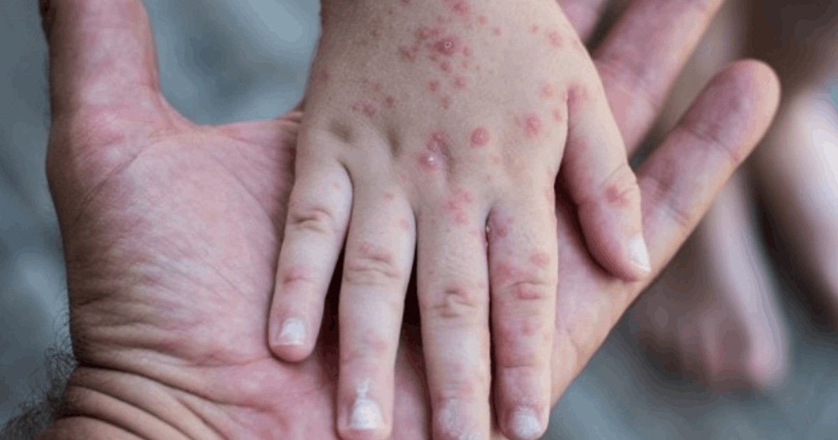 Musim Campak! Kemenkes Bagikan Tips Mudik Aman Anak untuk Orang Tua