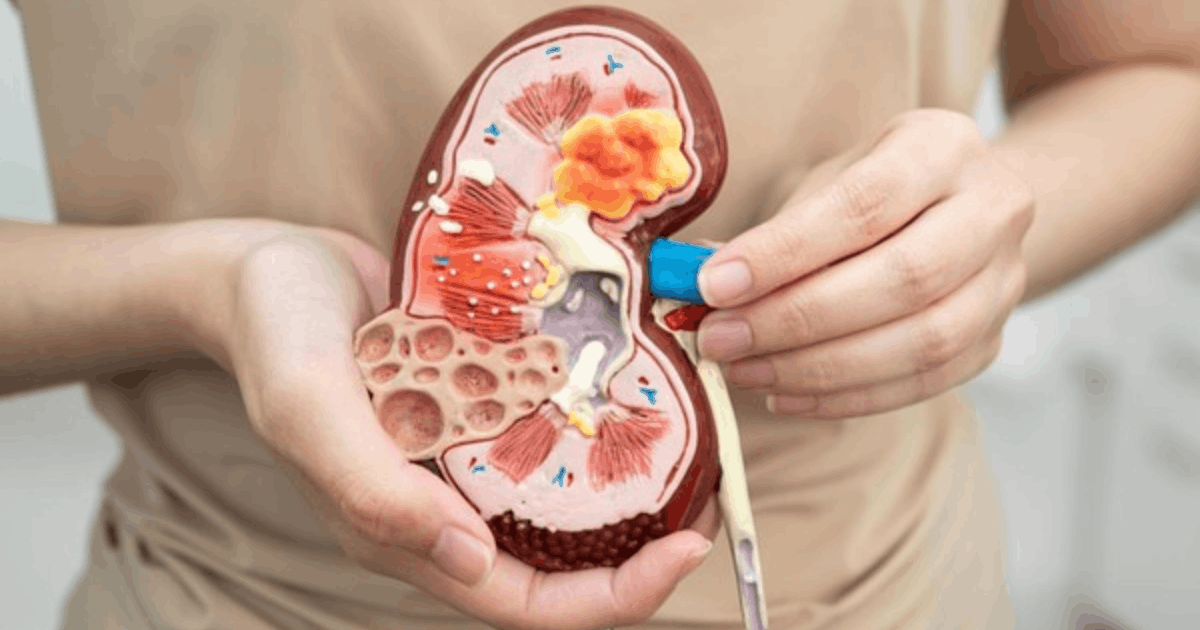 Waspada! Kenali Gejala Kanker Ginjal yang Terlihat dari Warna Urine