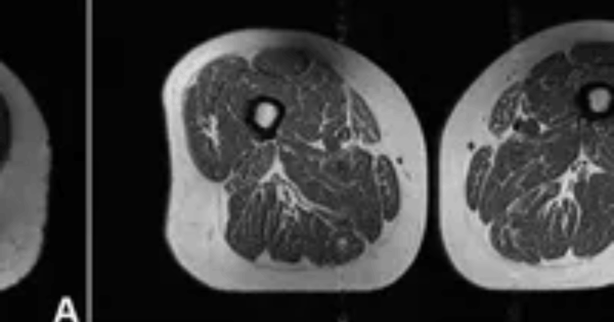 Dampak Makanan UPF Tubuh: Mengerikan! Potret Medis Ungkap Konsumsi Makanan Ultra-Proses Ubah Jaringan Paha Manusia Menyerupai Daging Berlemak!