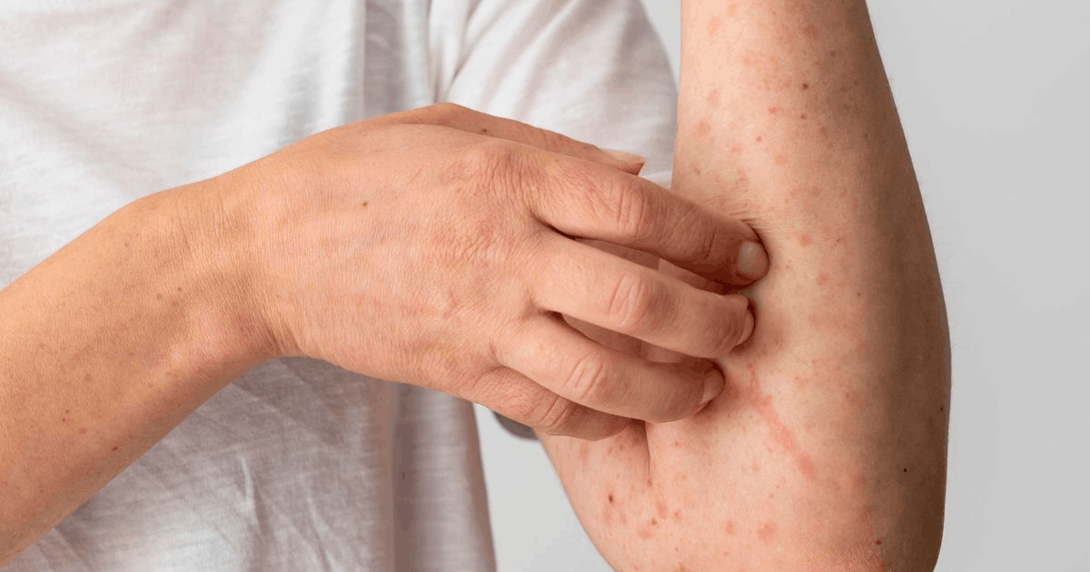 Bahaya Komplikasi Campak Pneumonia: Bukan Cuma Ruam! Waspada Komplikasi Campak yang Bisa Berujung pada Pneumonia Mematikan!