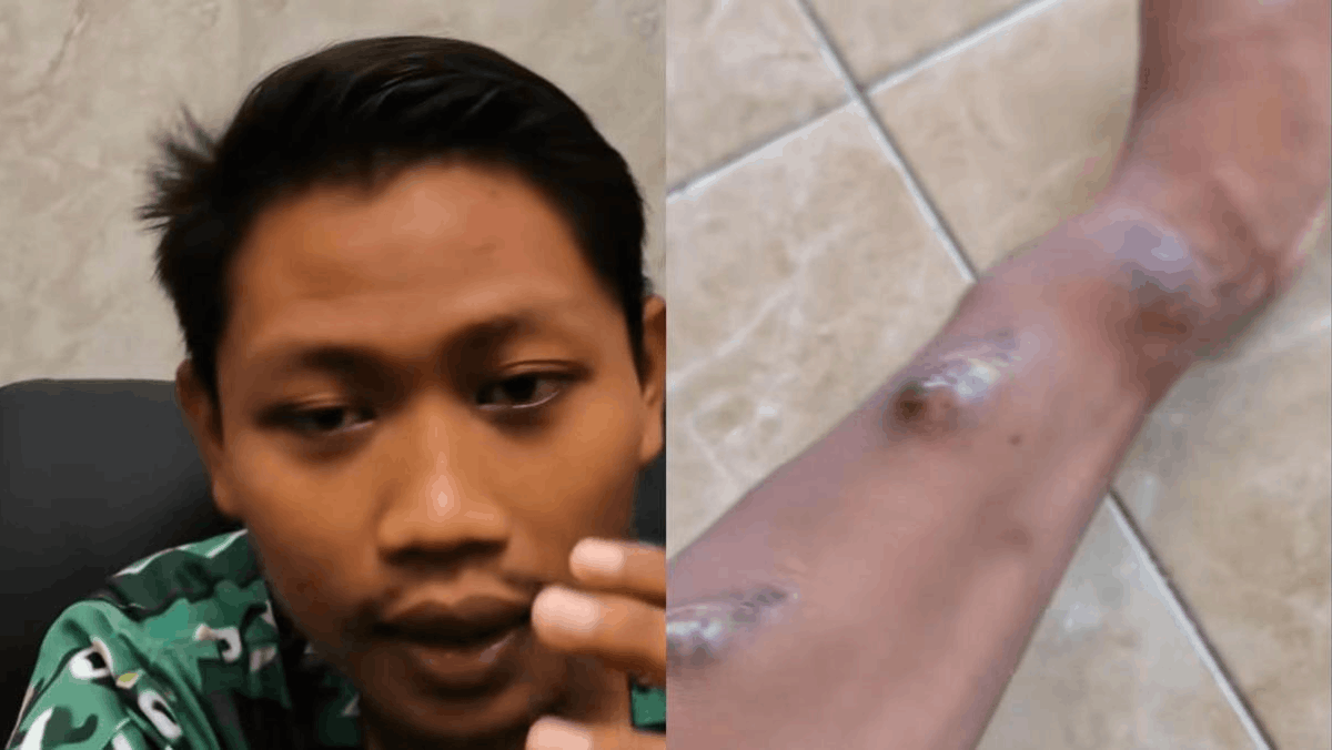 Kisah Pria Tuban Cuci Darah Usia 20-an: Waspada Gagal Ginjal Muda